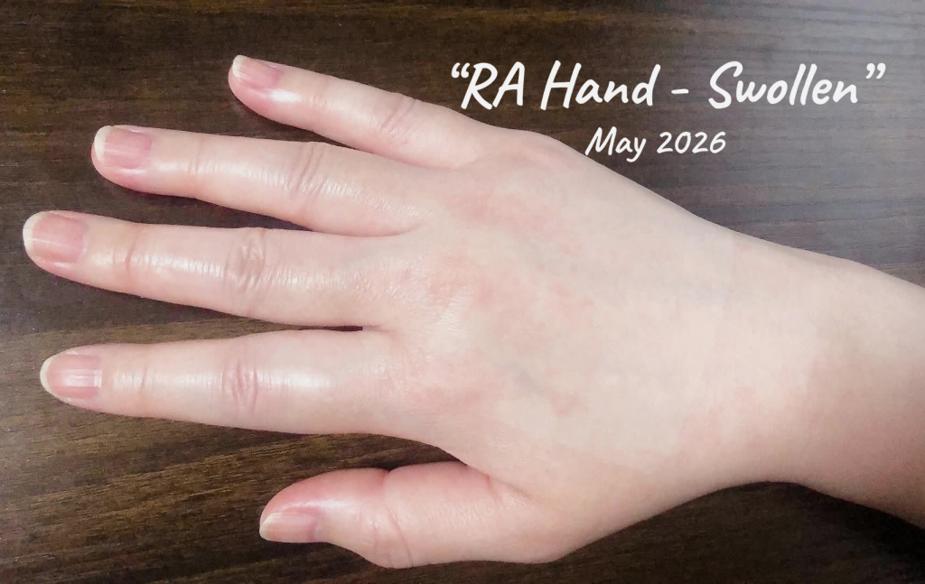 RAhand1-1024x647 体の中で何かが入れ替わった｜AIとくぐり抜けた、関節リウマチとコロナ後遺症パロスミアの1ヶ月